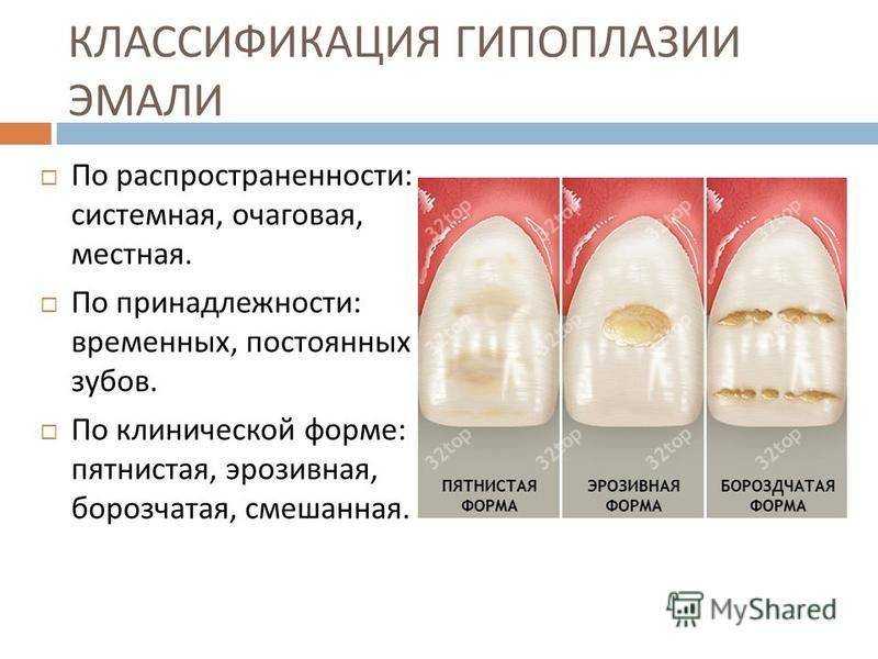 Точки и пятна на зубах | «см-стоматология»